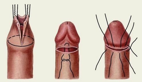 пенис кеңейтүү хирургиясынын маңызы