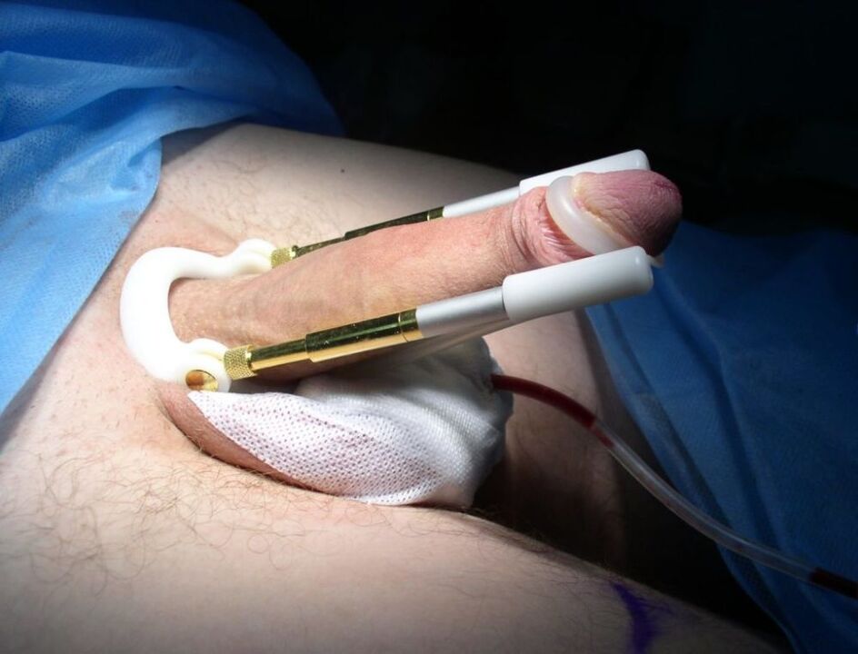 пенис чоңойтуу операциясынан кийин кеңейтүүчү