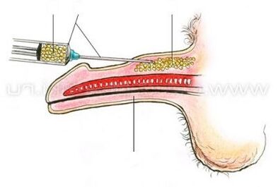 Injection Penis чоңойтуу